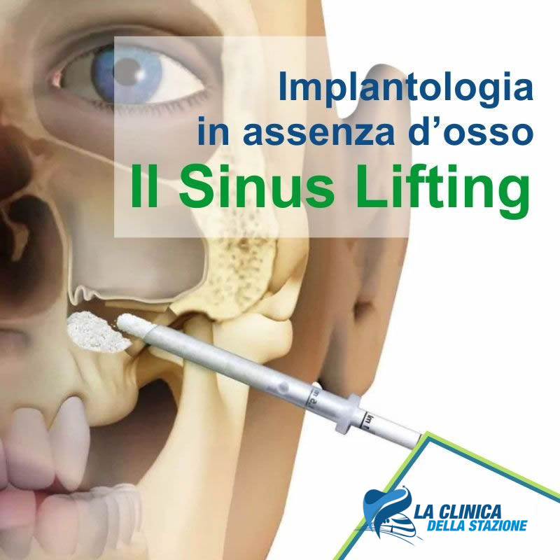 Implantologia senza osso, il Sinus Lifting